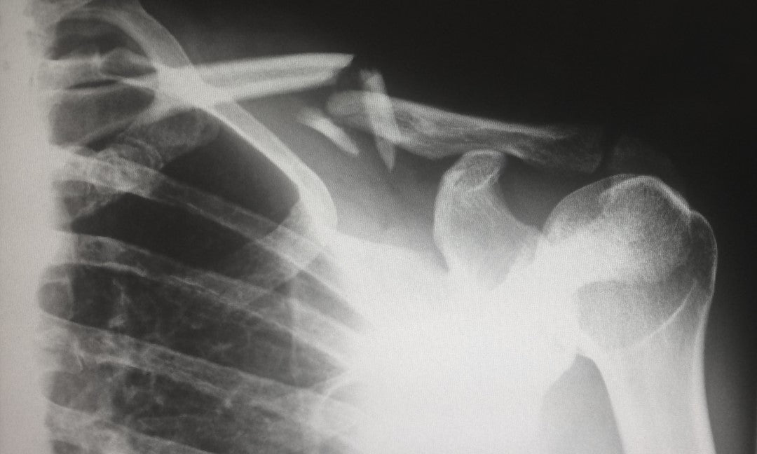shoulder xray